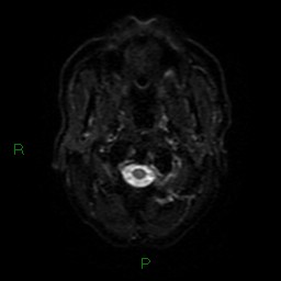 Cerebral amyloid angiopathy (Radiopaedia 77506-89664 Axial DWI 29).jpg
