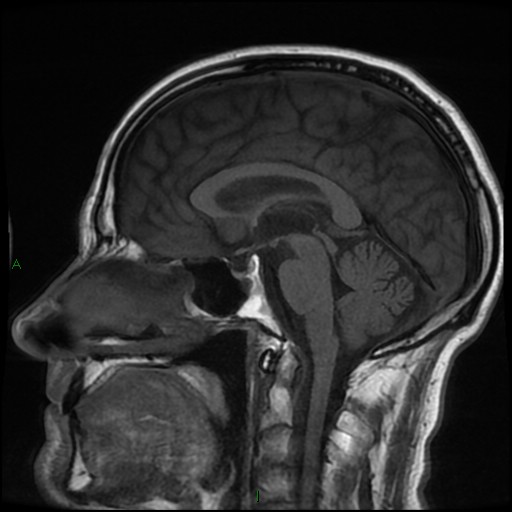 File:Cerebral amyloid angiopathy (Radiopaedia 77506-89664 Coronal T1 14).jpg
