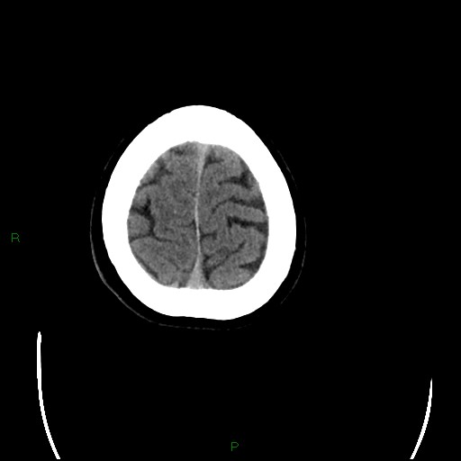 Cerebral amyloid angiopathy (Radiopaedia 77506-89665 Axial non-contrast 100).jpg