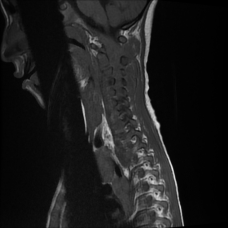 File:Cerebral and spinal tuberculosis (Radiopaedia 90489-107838 Sagittal T1 9).jpg