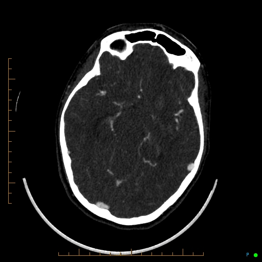 Cerebral arteriovenous malformation (AVM) (Radiopaedia 78162-90706 Axial CTA 124).jpg