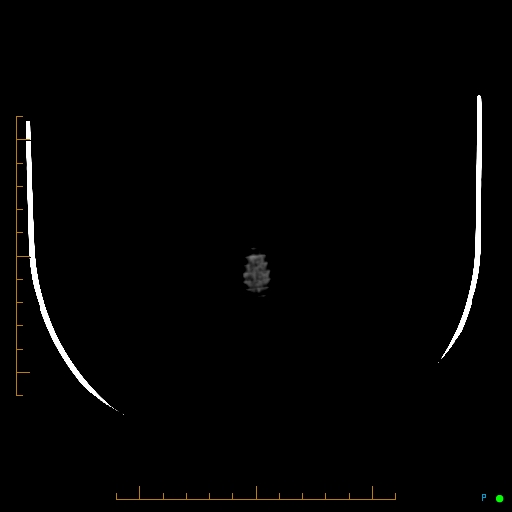 Cerebral arteriovenous malformation (AVM) (Radiopaedia 78162-90706 Axial non-contrast 67).jpg