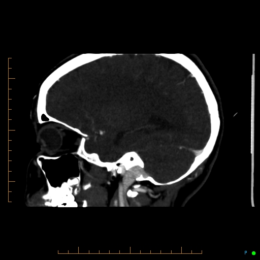 Cerebral arteriovenous malformation (AVM) (Radiopaedia 78162-90706 Sagittal CTA 55).jpg