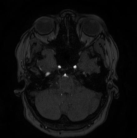 Cerebral arteriovenous malformation (Radiopaedia 74411-85654 Axial MRA 16).jpg