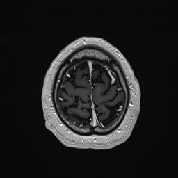 Cerebral arteriovenous malformation (Radiopaedia 84015-99245 Axial T1 C+ 138).jpg