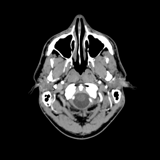 Cerebral arteriovenous malformation (Spetzler-Martin grade 2) (Radiopaedia 41262-44076 Axial C+ 3).png