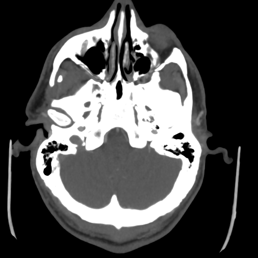 Cerebral arteriovenous malformation (Spetzler-Martin grade 2) (Radiopaedia 41262-44076 E 11).png
