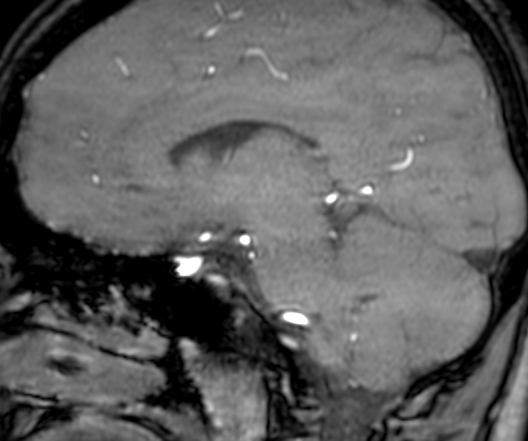 Cerebral arteriovenous malformation at posterior body of corpus callosum (Radiopaedia 74111-84925 J 219).jpg