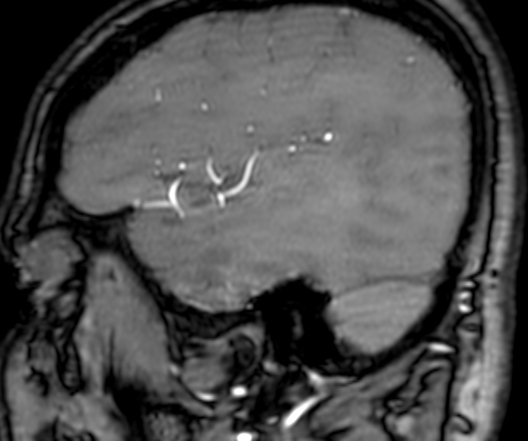 Cerebral arteriovenous malformation at posterior body of corpus callosum (Radiopaedia 74111-84925 J 61).jpg