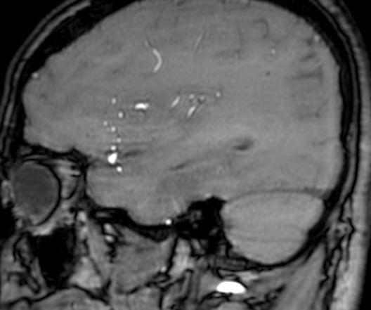 Cerebral arteriovenous malformation at posterior body of corpus callosum (Radiopaedia 74111-84925 J 87).jpg