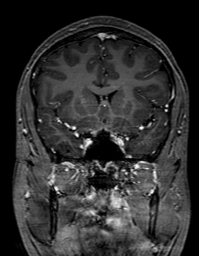 Cerebral arteriovenous malformation at posterior body of corpus callosum (Radiopaedia 74111-84925 K 127).jpg