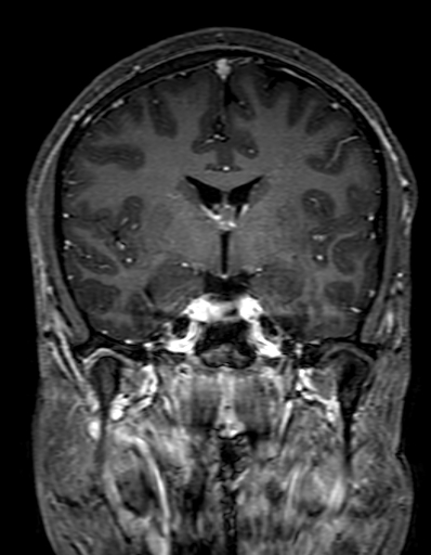 Cerebral arteriovenous malformation at posterior body of corpus callosum (Radiopaedia 74111-84925 K 164).jpg