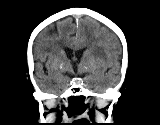 Cerebral arteriovenous malformation with lobar hemorrhage (Radiopaedia 44725-48510 Coronal non-contrast 24).png