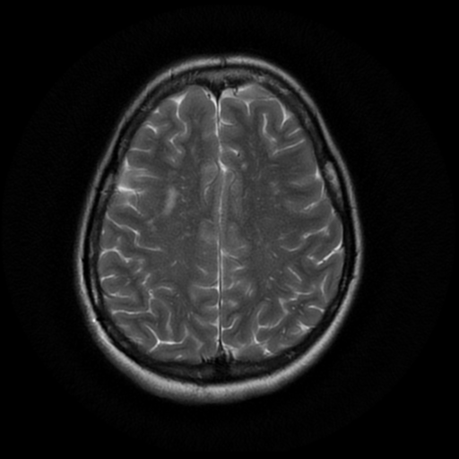 File:Cerebral autosomal dominant arteriopathy with subcortical infarcts and leukoencephalopathy (CADASIL) (Radiopaedia 41018-43763 Ax T2 PROP 15).png