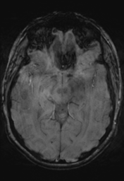 File:Cerebral cavernoma and development venous anomaly (Radiopaedia 37603-39482 Axial SWI 18).png