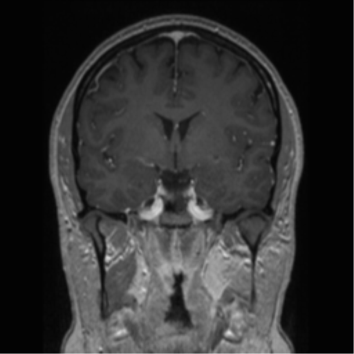 Cerebral cavernoma and development venous anomaly (Radiopaedia 37603-39482 Coronal T1 C+ 55).png