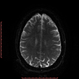 File:Cerebral cavernous malformation (Radiopaedia 26177-26306 Axial DWI 35).jpg