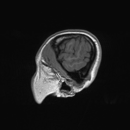 File:Cerebral cavernous venous malformation (Radiopaedia 70008-80021 Sagittal T1 69).jpg