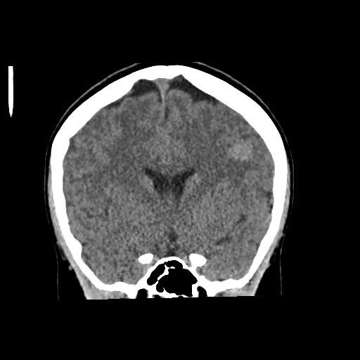 Cerebral cavernous venous malformation (Radiopaedia 70008-80022 non-contrast 30).jpg