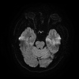 Cerebral cavernous venous malformation (Zabramski type II) (Radiopaedia 85511-101198 Axial DWI 45).jpg