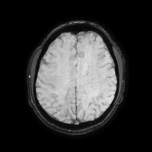 Cerebral cavernous venous malformation (Zabramski type II) (Radiopaedia 85511-101198 Axial SWI 83).jpg