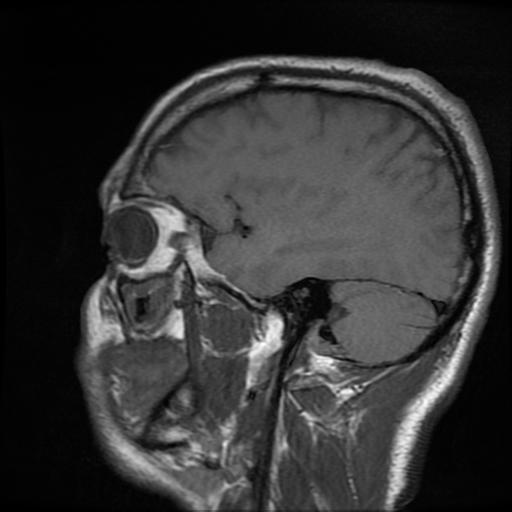 File:Cerebral cavernous venous malformation (Zabramski type II) (Radiopaedia 85511-101198 Sagittal T1 11).jpg