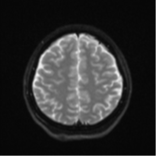 Cerebral cavernous venous malformations (Radiopaedia 48117-52946 Axial DWI 21).png