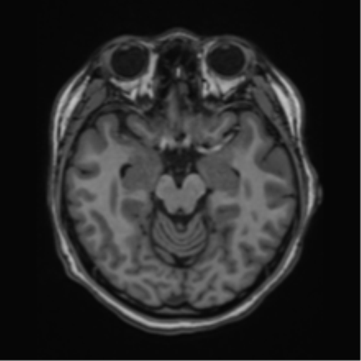 File:Cerebral cavernous venous malformations (Radiopaedia 48117-52946 Axial T1 10).png