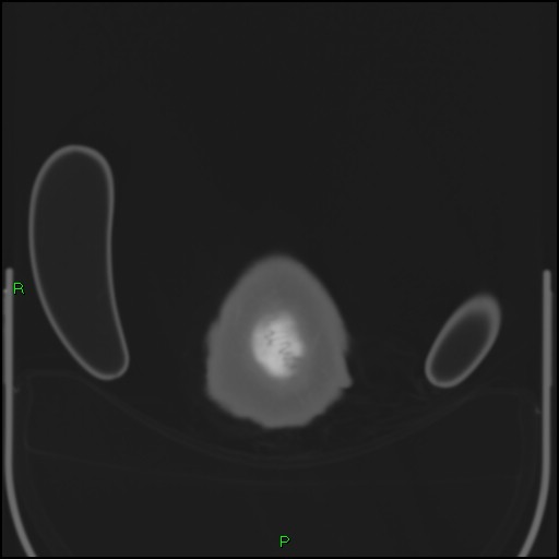 Cerebral contusions (Radiopaedia 33868-35039 Axial bone window 228).jpg