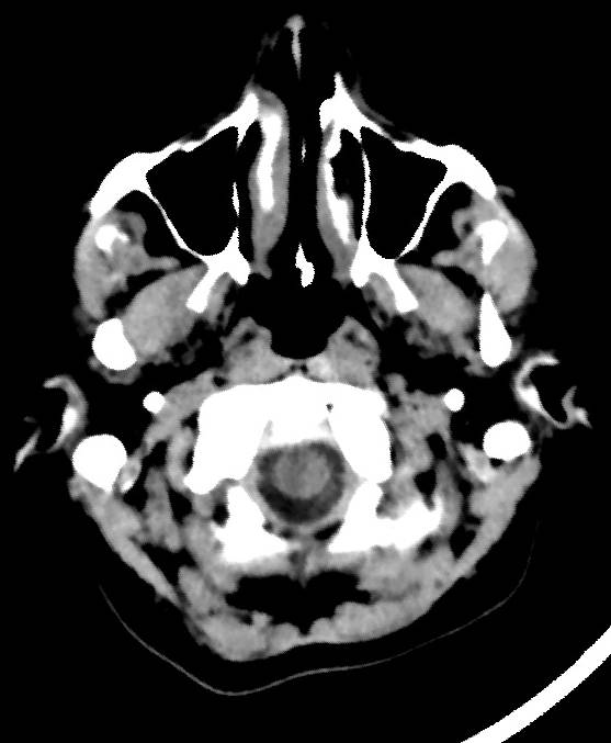Cerebral edema due to severe hyponatremia (Radiopaedia 89826-106937 Axial non-contrast 5).jpg