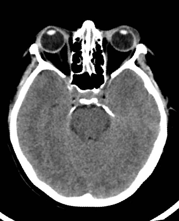 Cerebral edema due to severe hyponatremia (Radiopaedia 89826-106938 Axial non-contrast 37).jpg