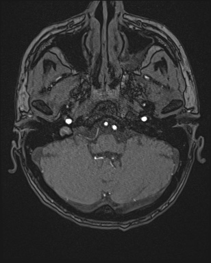 Cerebral embolic infarcts (embolic shower) (Radiopaedia 72391-82921 Axial MRA 13).jpg