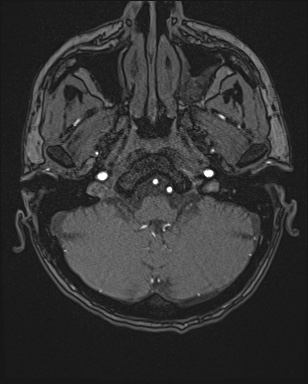 Cerebral embolic infarcts (embolic shower) (Radiopaedia 72391-82921 Axial MRA 8).jpg