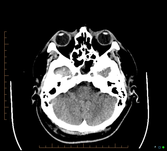 Cerebral fat embolism (Radiopaedia 85521-101220 Axial non-contrast 19).jpg
