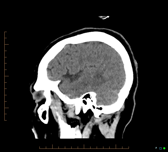 Cerebral fat embolism (Radiopaedia 85521-101220 B 43).jpg