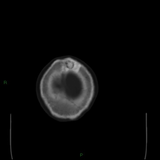 Cerebral metastases - breast primary (Radiopaedia 77653-89857 Axial bone window 112).jpg