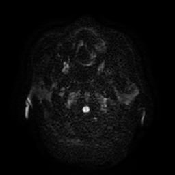 Cerebral metastases - melanoma (Radiopaedia 80972-94522 Axial DWI 34).jpg
