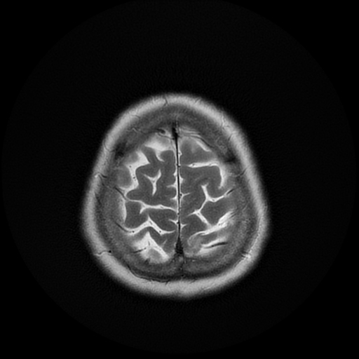 File:Cerebral metastases - melanoma (Radiopaedia 80972-94522 Axial T2 27).jpg
