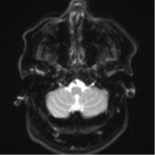 Cerebral metastases mimicking multifocal glioblastoma (Radiopaedia 50843-56353 Axial DWI 4).png