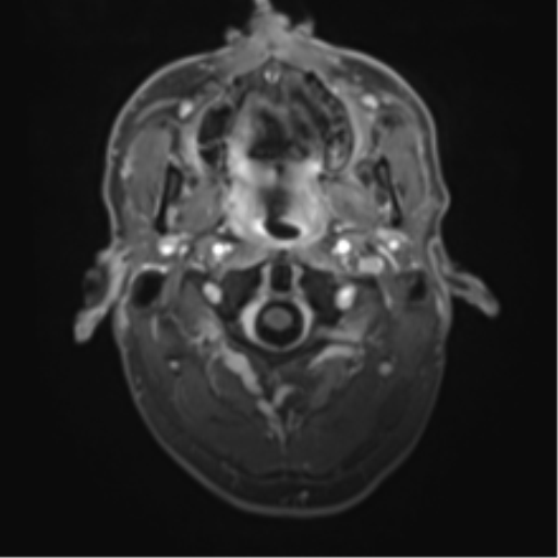 Cerebral metastasis - melanoma (Radiopaedia 54718-60954 Axial T1 C+ fat sat 2).png
