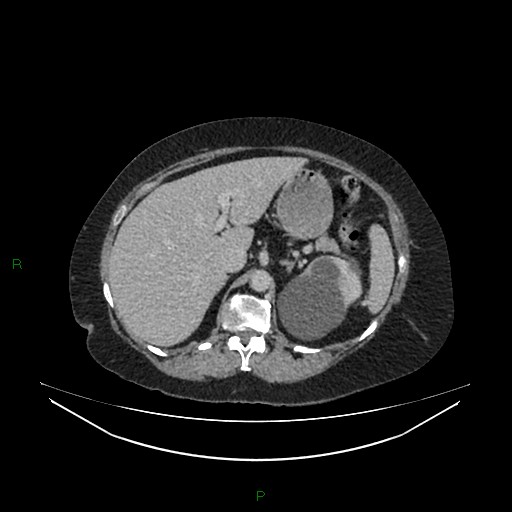 Cerebral metastasis from renal cell carcinoma (Radiopaedia 82306-96378 A 45).jpg