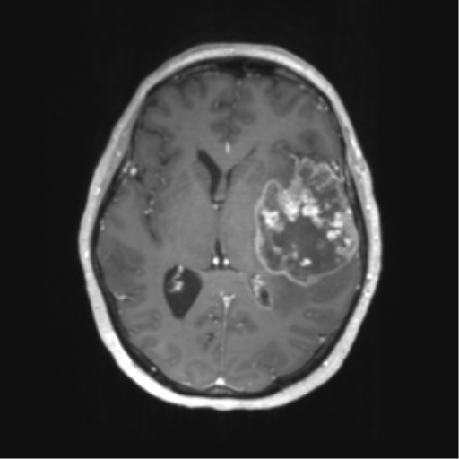 File:Cerebral metastasis mimicking glioblastoma (Radiopaedia 69155-78937 Axial T1 C+ 33).png