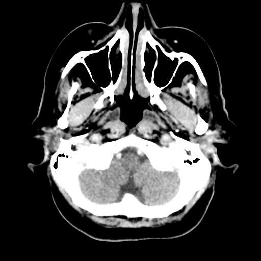 Cerebral metastasis to basal ganglia (Radiopaedia 81568-95412 Axial C+ delayed 11).png