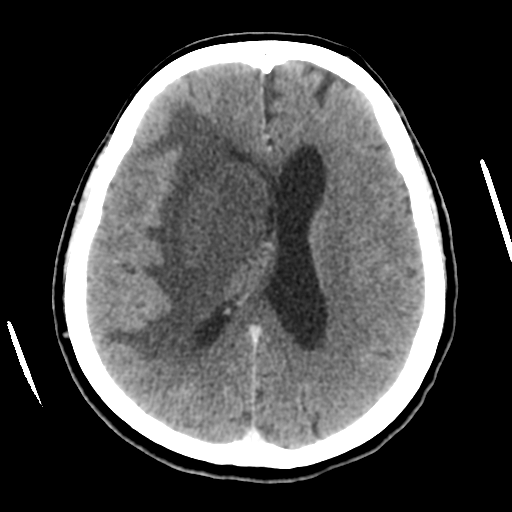 File:Cerebral metastasis to basal ganglia (Radiopaedia 81568-95412 Axial C+ delayed 36).png