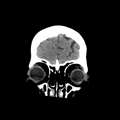 Cerebral metastasis to basal ganglia (Radiopaedia 81568-95412 Coronal non-contrast 14).png