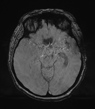 Cerebral metastasis to basal ganglia (Radiopaedia 81568-95413 Axial SWI magnitude 33).png