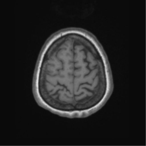 Cerebral metastasis to basal ganglia (Radiopaedia 81568-95413 Axial T1 64).png