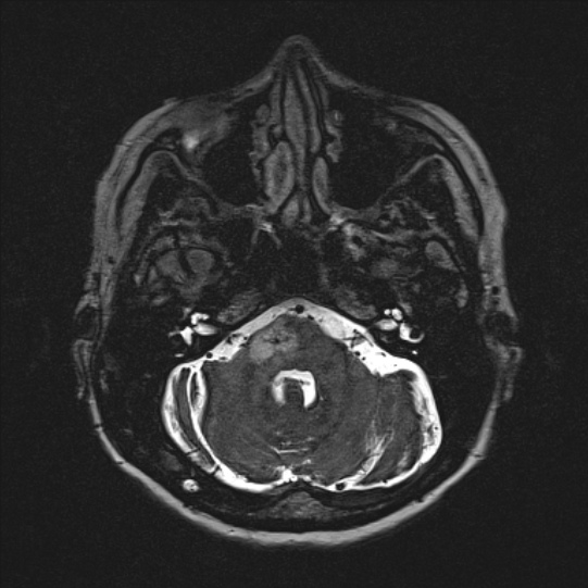 Cerebral ring enhancing lesions - cerebral metastases (Radiopaedia 44922-48817 F 31).jpg