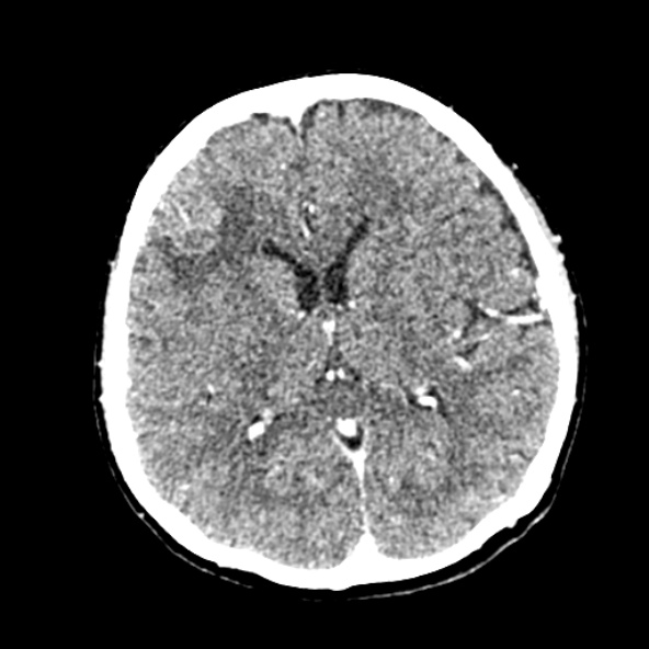 Cerebral ring enhancing lesions - cerebral metastases (Radiopaedia 44922-48818 B 160).jpg