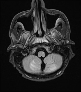 File:Cerebral toxoplasmosis (Radiopaedia 43956-47461 Axial FLAIR 3).jpg